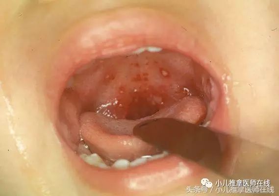 喉咙里长泡泡是什么病图片